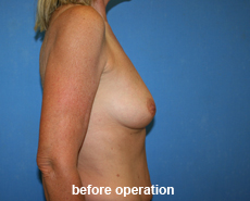 plastic-surgery-breast-augmentation